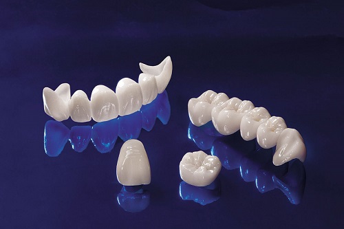 Tư vấn giá làm răng sứ venus phù hợp cho từng trường hợp 1 Tư vấn giá làm răng sứ venus phù hợp cho từng trường hợp 1