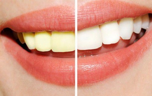 Sử dụng miếng tẩy trắng răng cần lưu ý điều gì? 3 Sử dụng miếng tẩy trắng răng cần lưu ý điều gì? 3