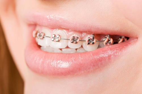 Niềng 4 răng cửa có được không? Thực hiện phương pháp niềng răng nào? 1 Niềng 4 răng cửa có được không? Thực hiện phương pháp niềng răng nào? 1