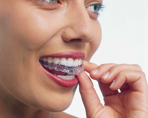 Niềng 4 răng cửa có được không? Thực hiện phương pháp niềng răng nào? 3 Niềng 4 răng cửa có được không? Thực hiện phương pháp niềng răng nào? 3