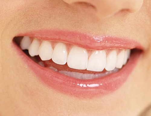 Niềng 4 răng cửa có được không? Thực hiện phương pháp niềng răng nào? 4 Niềng 4 răng cửa có được không? Thực hiện phương pháp niềng răng nào? 4