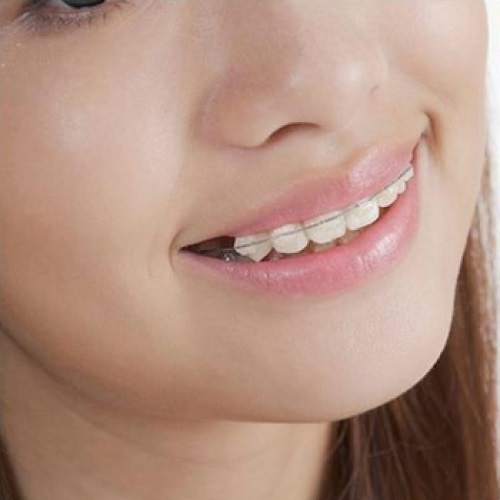 Tư vấn về vấn đề niềng răng có nguy hiểm không cho bạn? 1 Tư vấn về vấn đề niềng răng có nguy hiểm không cho bạn? 1