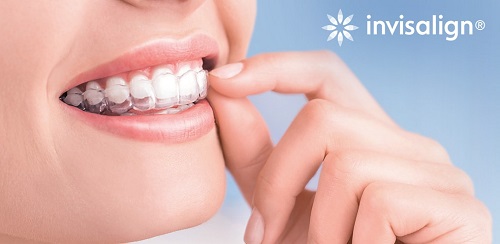 Tư vấn về vấn đề niềng răng có nguy hiểm không cho bạn? 2 Tư vấn về vấn đề niềng răng có nguy hiểm không cho bạn? 2