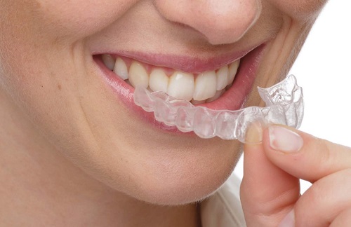 Phương pháp niềng răng không mắc cài 3D Clear Aligner 2 Phương pháp niềng răng không mắc cài 3D Clear Aligner 2
