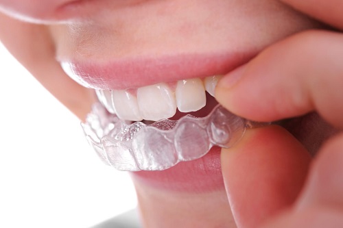 Phương pháp niềng răng không mắc cài 3D Clear Aligner 3 Phương pháp niềng răng không mắc cài 3D Clear Aligner 3