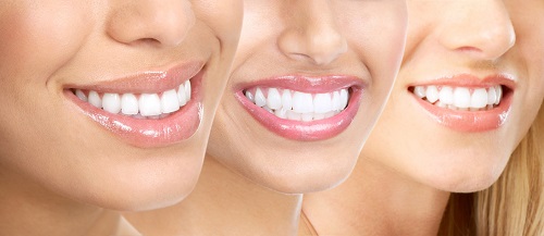 Phương pháp niềng răng không mắc cài 3D Clear Aligner 4 Phương pháp niềng răng không mắc cài 3D Clear Aligner 4