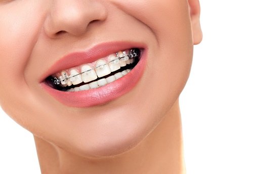 Niềng răng khớp cắn hở thực hiện như thế nào? 1 Niềng răng khớp cắn hở thực hiện như thế nào? 1