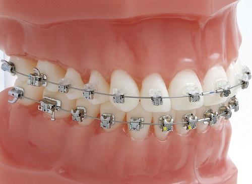 Niềng răng khớp cắn hở thực hiện như thế nào? 2 Niềng răng khớp cắn hở thực hiện như thế nào? 2