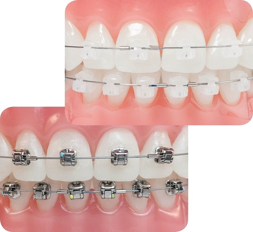Niềng răng mắc cài 3m ugsl sử dụng cho trường hợp nào 1 Niềng răng mắc cài 3m ugsl sử dụng cho trường hợp nào 1