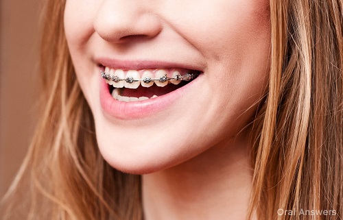 Niềng răng mắc cài 3m ugsl sử dụng cho trường hợp nào 2 Niềng răng mắc cài 3m ugsl sử dụng cho trường hợp nào 2