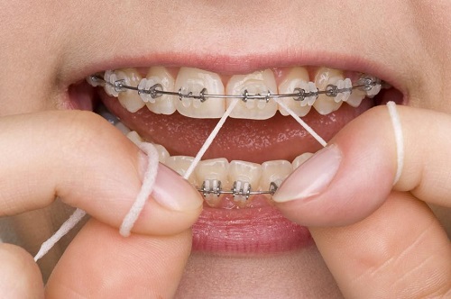 Niềng răng mắc cài 3m ugsl sử dụng cho trường hợp nào 4 Niềng răng mắc cài 3m ugsl sử dụng cho trường hợp nào 4