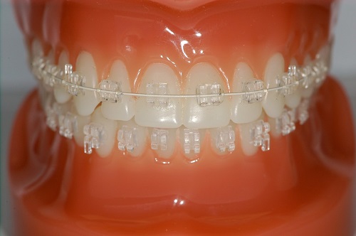 Niềng răng mắc cài pha lê hiệu quả không? 1 Niềng răng mắc cài pha lê hiệu quả không? 1