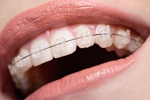 Niềng răng mắc cài pha lê hiệu quả không? 2 Niềng răng mắc cài pha lê hiệu quả không? 2