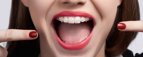 Niềng răng mắc cài pha lê hiệu quả không? 3 Niềng răng mắc cài pha lê hiệu quả không? 3