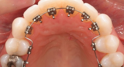 Niềng răng mặt trong giá rẻ nhất ở đâu? 1 Niềng răng mặt trong giá rẻ nhất ở đâu? 1