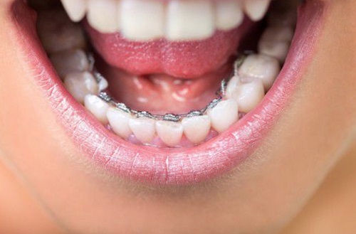 Niềng răng mặt trong giá rẻ nhất ở đâu? 2 Niềng răng mặt trong giá rẻ nhất ở đâu? 2