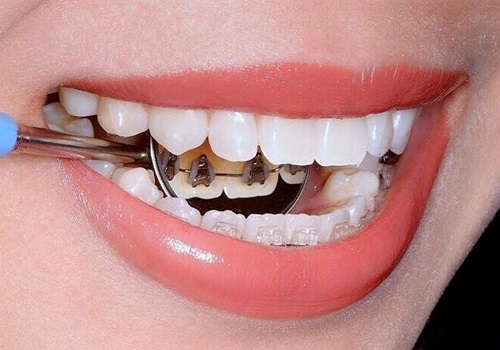Niềng răng mặt trong giá rẻ nhất ở đâu? 3 Niềng răng mặt trong giá rẻ nhất ở đâu? 3