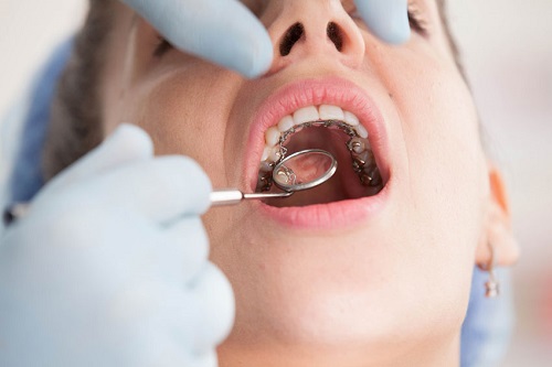 Niềng răng mặt trong giá rẻ nhất ở đâu? 4 Niềng răng mặt trong giá rẻ nhất ở đâu? 4