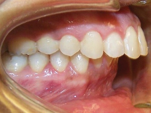 Bị niềng răng sai khớp cắn phải xử lý ra sao? 1 Bị niềng răng sai khớp cắn phải xử lý ra sao? 1
