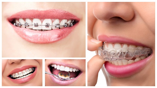 Bị niềng răng sai khớp cắn phải xử lý ra sao? 4 Bị niềng răng sai khớp cắn phải xử lý ra sao? 4