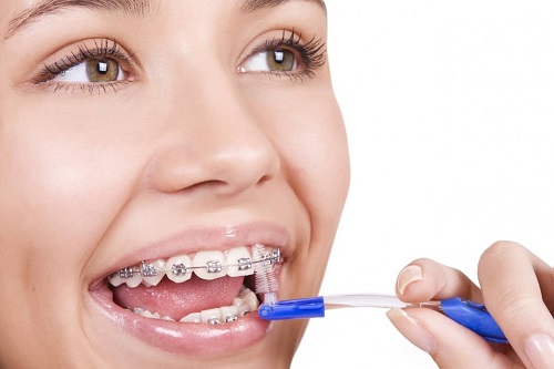 Niềng răng thẩm mỹ giá bao nhiêu tiền là có hàm răng đẹp 2 Niềng răng thẩm mỹ giá bao nhiêu tiền là có hàm răng đẹp 2