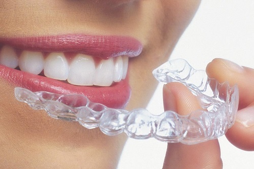 Niềng răng thẩm mỹ giá bao nhiêu tiền là có hàm răng đẹp 3 Niềng răng thẩm mỹ giá bao nhiêu tiền là có hàm răng đẹp 3