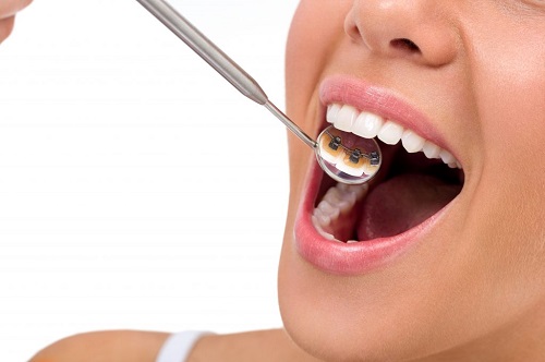 Niềng răng thẩm mỹ là gì? Các loại niềng răng thẩm mỹ hiện nay 3 Niềng răng thẩm mỹ là gì? Các loại niềng răng thẩm mỹ hiện nay 3