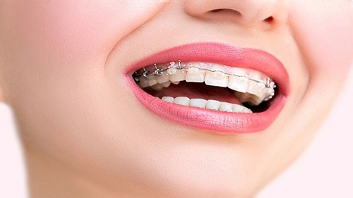 Niềng răng thưa 1 hàm giá bao nhiêu tiền là được? 2 Niềng răng thưa 1 hàm giá bao nhiêu tiền là được? 2
