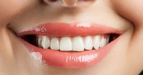 Răng sứ bị đen viền nướu nguyên nhân chính do đâu? 2 Răng sứ bị đen viền nướu nguyên nhân chính do đâu? 2