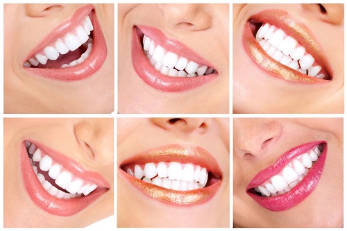 Răng sứ bị đen viền nướu nguyên nhân chính do đâu? 4 Răng sứ bị đen viền nướu nguyên nhân chính do đâu? 4