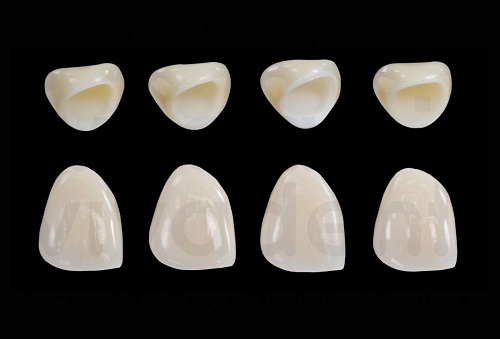 Bọc răng sứ titan có bị đen không? 1 Bọc răng sứ titan có bị đen không? 1