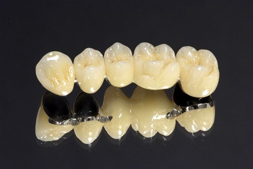 Răng sứ titan sử dụng được bao lâu? 1 Răng sứ titan sử dụng được bao lâu? 1