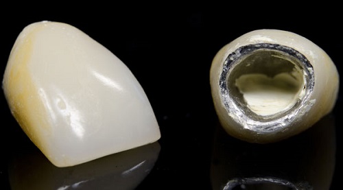 Răng sứ titan sử dụng được bao lâu? 3 Răng sứ titan sử dụng được bao lâu? 3