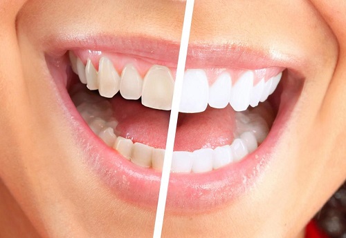 Răng sứ titan sử dụng được bao lâu? 4 Răng sứ titan sử dụng được bao lâu? 4