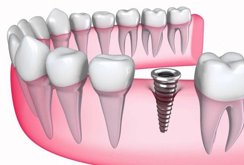 Tư vấn trồng răng implant ở đâu tốt cho bạn 1
