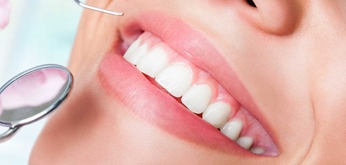 Bọc răng sứ nguyên hàm giá bao nhiêu là có thể thực hiện 4 Bọc răng sứ nguyên hàm giá bao nhiêu là có thể thực hiện 4
