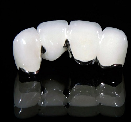 Chụp răng sứ giá bao nhiêu cho từng trường hợp? 2 Chụp răng sứ giá bao nhiêu cho từng trường hợp? 2