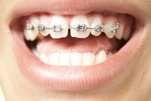 Niềng răng hàm trên giá bao nhiêu tiền phụ thuộc vào yếu tố nào? 1 Niềng răng hàm trên giá bao nhiêu tiền phụ thuộc vào yếu tố nào? 1