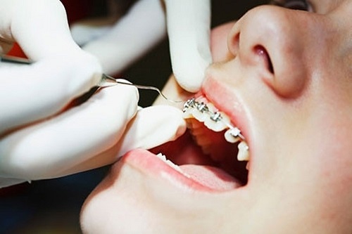 Niềng răng hàm trên giá bao nhiêu tiền phụ thuộc vào yếu tố nào? 3 Niềng răng hàm trên giá bao nhiêu tiền phụ thuộc vào yếu tố nào? 3