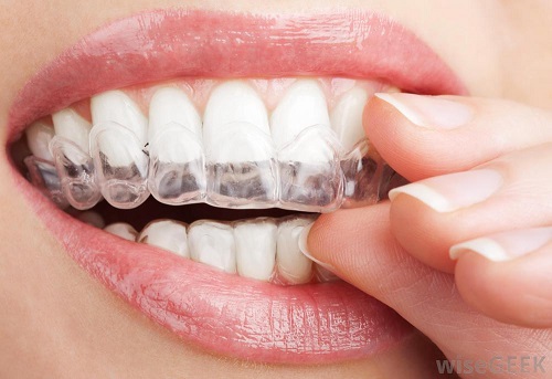 Niềng răng hàm trên giá bao nhiêu tiền phụ thuộc vào yếu tố nào? 4 Niềng răng hàm trên giá bao nhiêu tiền phụ thuộc vào yếu tố nào? 4
