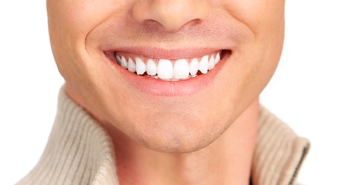 Niềng răng khểnh mấy bao lâu thì đều và đẹp 1 Niềng răng khểnh mấy bao lâu thì đều và đẹp 1