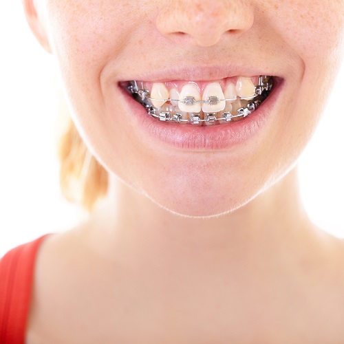 Niềng răng khểnh mấy bao lâu thì đều và đẹp 2 Niềng răng khểnh mấy bao lâu thì đều và đẹp 2
