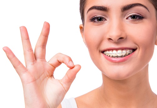 Niềng răng khểnh mấy bao lâu thì đều và đẹp 4 Niềng răng khểnh mấy bao lâu thì đều và đẹp 4