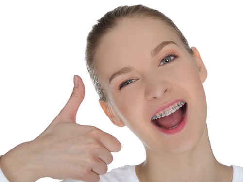 Niềng răng móm trong bao lâu là hoàn thành? 1 Niềng răng móm trong bao lâu là hoàn thành? 1