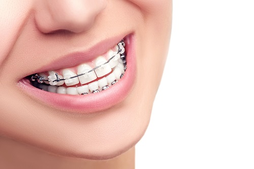Niềng răng móm trong bao lâu là hoàn thành? 3 Niềng răng móm trong bao lâu là hoàn thành? 3