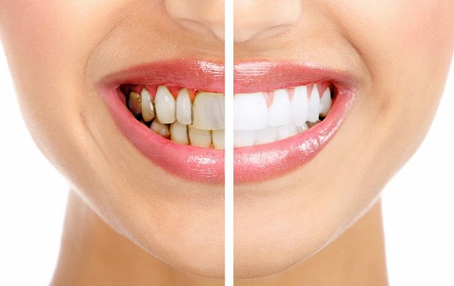 Tẩy trắng răng bằng đèn plasma giá bao nhiêu? 1 Tẩy trắng răng bằng đèn plasma giá bao nhiêu? 1