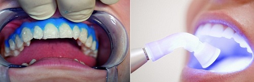 Tẩy trắng răng bằng đèn plasma giá bao nhiêu? 2 Tẩy trắng răng bằng đèn plasma giá bao nhiêu? 2