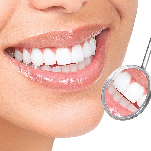 Tẩy trắng răng có ảnh hưởng gì không? Chia sẻ từ chuyên gia 2 Tẩy trắng răng có ảnh hưởng gì không? Chia sẻ từ chuyên gia 2
