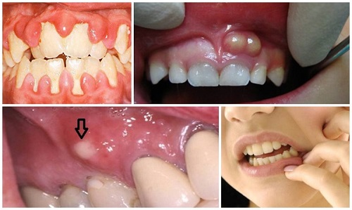 Chảy máu chân răng khi đánh răng có ảnh hưởng gì không? 2