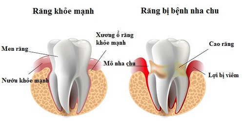 Chảy máu chân răng khi đánh răng có ảnh hưởng gì không? 3